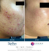 SKINPEN KUR AF ANSIGT + HALS M. 3 BEHANDLINGER (INKL. EFTERBEHANDLINGSCREMER)