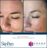 SKINPEN ANSIGT ELLER HALS 1 BEHANDLING (INKL. EFTERBEHANDLINGSCREMER)