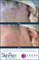 SKINPEN ANSIGT ELLER HALS 1 BEHANDLING (INKL. EFTERBEHANDLINGSCREMER)
